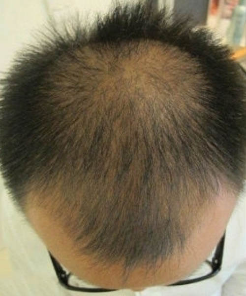 Antes